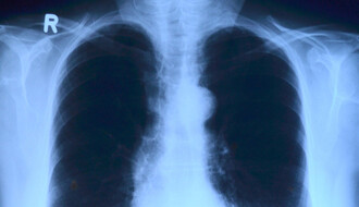 U Srbiji iz godine u godinu raste broj obolelih od tuberkuloze